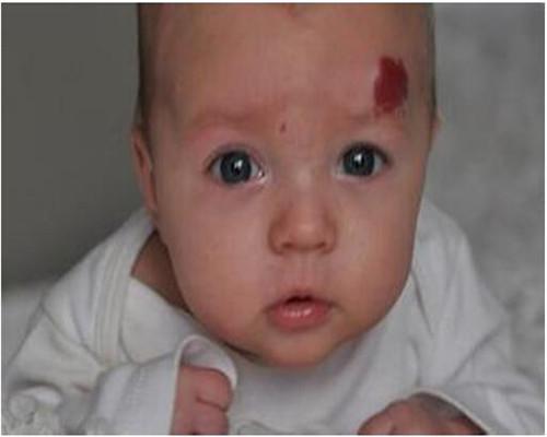 婴儿各种胎记(史上最全的宝宝)(2)