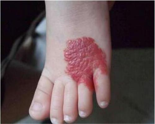 婴儿各种胎记(史上最全的宝宝)(3)