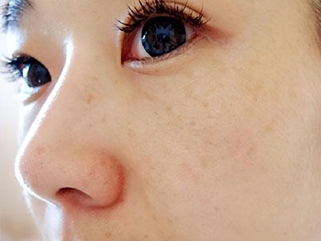 如何快速去掉脸上的斑(这五个方法最为简单)