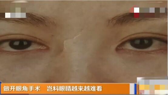 美容院可以做开眼角手术吗（百姓观察四女子做完开眼角手术不对称）(5)