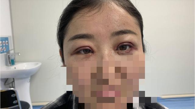 美容院可以做开眼角手术吗（百姓观察四女子做完开眼角手术不对称）(4)