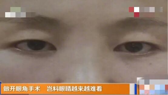 美容院可以做开眼角手术吗（百姓观察四女子做完开眼角手术不对称）(3)
