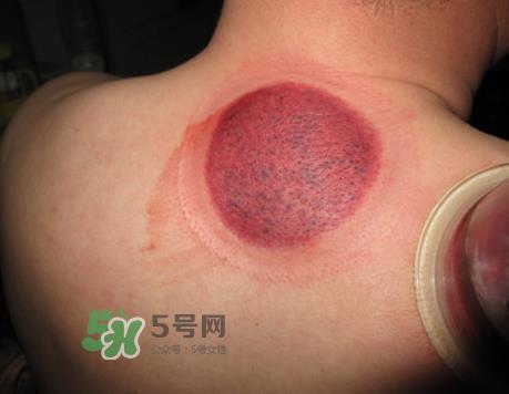 三伏天拔罐后多久可以洗澡?三伏天拔罐后注意事项 三伏天拔罐后多久可以洗澡?三伏天拔罐后注意事项