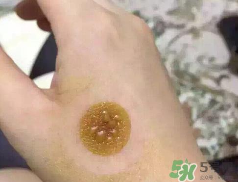 艾灸贴后有水泡怎么办?贴艾灸贴应注意些什么? 艾灸贴后有水泡怎么办?贴艾灸贴应注意些什么?