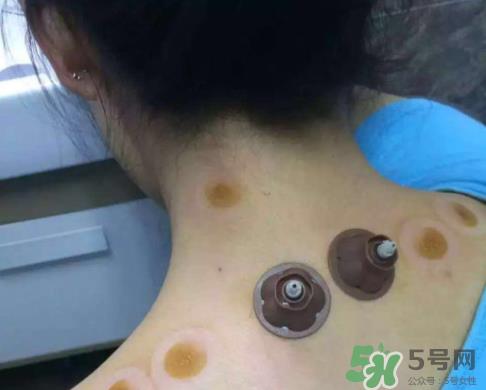 艾灸贴后有水泡怎么办?贴艾灸贴应注意些什么? 艾灸贴后有水泡怎么办?贴艾灸贴应注意些什么?