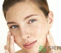 晒斑怎么形成的?晒斑怎么去除? 晒斑怎么形成的?晒斑怎么去除?