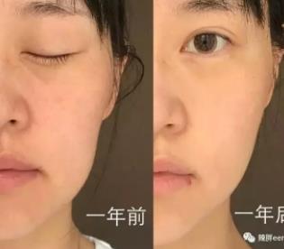 童颜机有用吗?童颜机的功效 童颜机有用吗?童颜机的功效