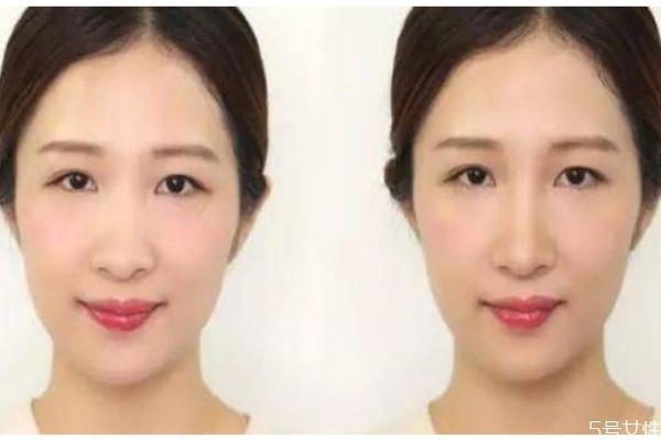 如何收缩鼻翼 收缩鼻翼的办法 如何收缩鼻翼 收缩鼻翼的办法