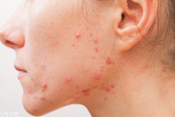 芙清凝胶有什么功效 芙清凝胶适合什么人 芙清凝胶有什么功效 芙清凝胶适合什么人