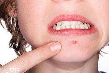 红肿痘痘怎么快速消肿 远离红肿痘痘大作战 红肿痘痘怎么快速消肿 远离红肿痘痘大作战