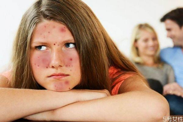 右脸长痘痘是为什么呢 右脸长痘痘的原因是什么呢 右脸长痘痘是为什么呢 右脸长痘痘的原因是什么呢