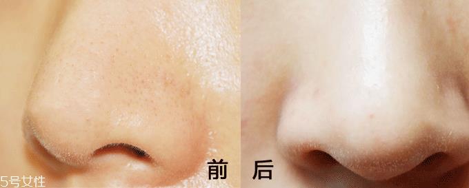 面膜什么成分能清洁毛孔 高岭土能深层清洁 面膜什么成分能清洁毛孔 高岭土能深层清洁