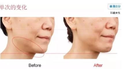 雅萌射频美容仪防水吗?雅萌Bloom射频美容仪可以水洗吗 雅萌射频美容仪防水吗?雅萌Bloom射频美容仪可以水洗吗