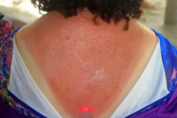 皮肤晒伤发红怎么修复 皮肤晒伤怎么处理最好 皮肤晒伤发红怎么修复 皮肤晒伤怎么处理最好