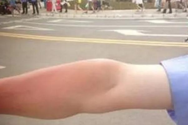 皮肤晒伤发红怎么修复 皮肤晒伤怎么处理最好 皮肤晒伤发红怎么修复 皮肤晒伤怎么处理最好