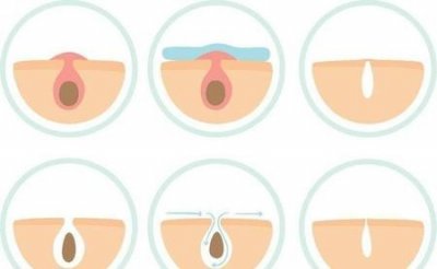 ​毛孔粗怎么解决(毛孔粗大怎么办)