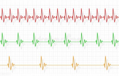 ​心跳慢的人要注意什么问题（心动过缓分哪几种情况？分别需要如何应对？）