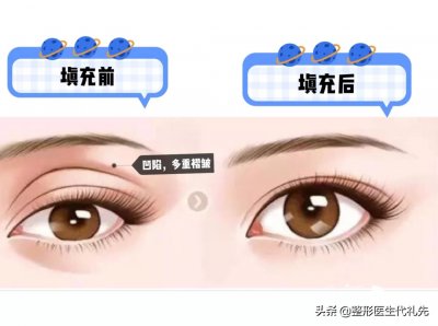 ​眼窝凹陷是什么原因怎么恢复（眼窝凹陷是什么原因？眼窝凹陷严重的图片？如何
