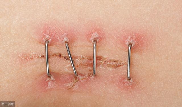 吴彦祖谈阑尾破裂原因(差点要了吴彦祖命的阑尾炎)(7)