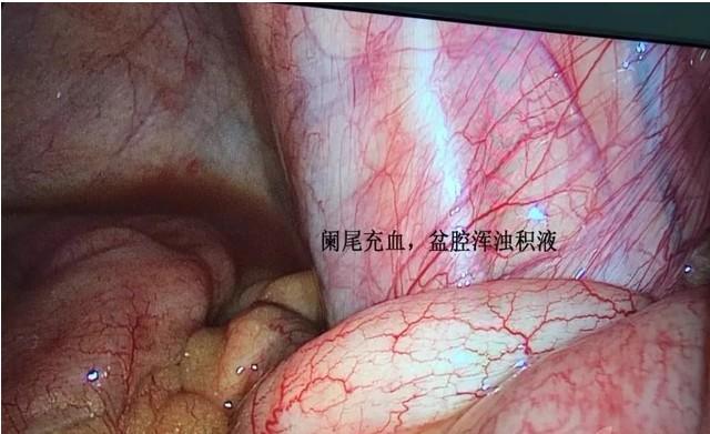 吴彦祖谈阑尾破裂原因(差点要了吴彦祖命的阑尾炎)(2)