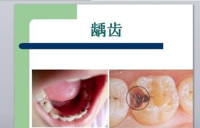 ​怎样缓解牙痛最快最有效(牙疼如何快速缓解)